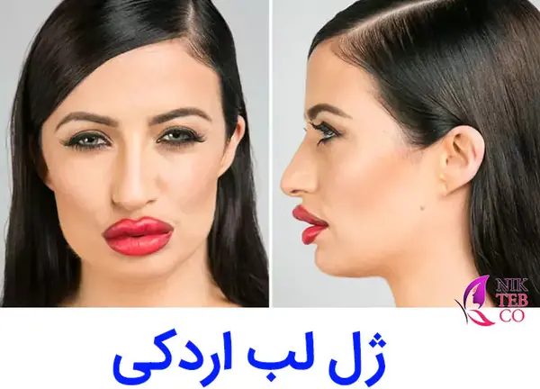 عکس لب ژل زده شده