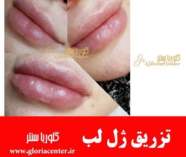 عکس لب ژل زده شده