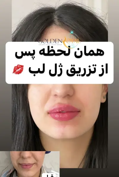 عکس ژل لب خنده دار