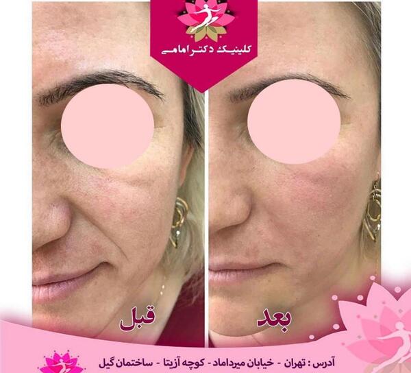 عکس ژل لب خنده دار