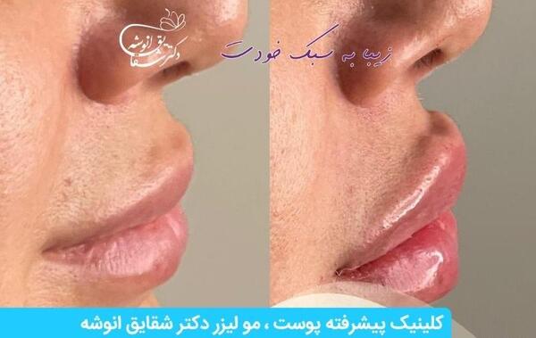 عکس ژل لب خنده دار
