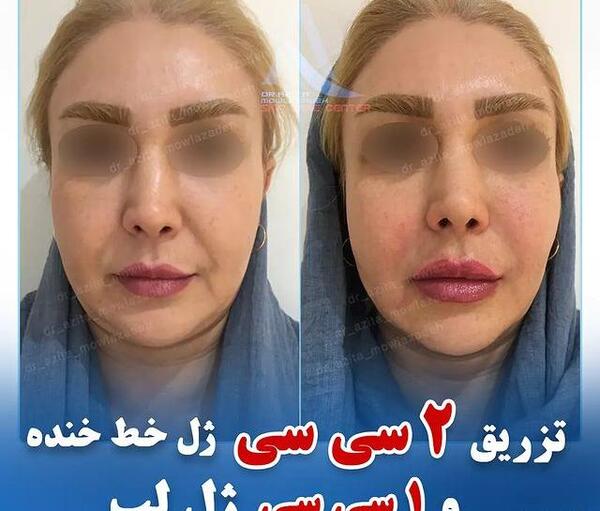 عکس ژل لب خنده دار