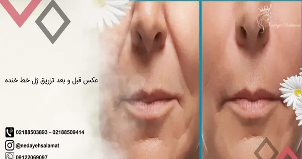 عکس ژل لب خنده دار