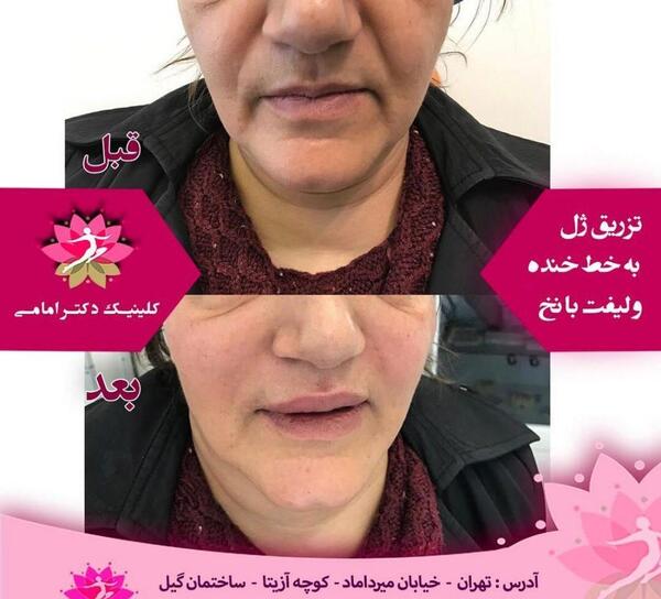 عکس ژل لب خنده دار