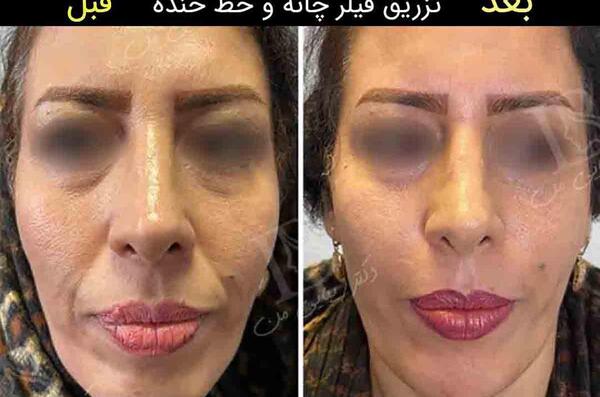 عکس ژل لب خنده دار