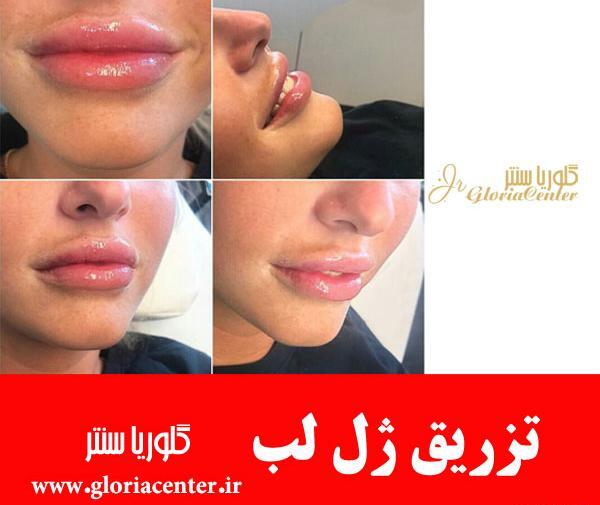 عکس لب پروتز شده خنده دار