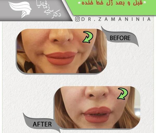 عکس لب پروتز شده خنده دار