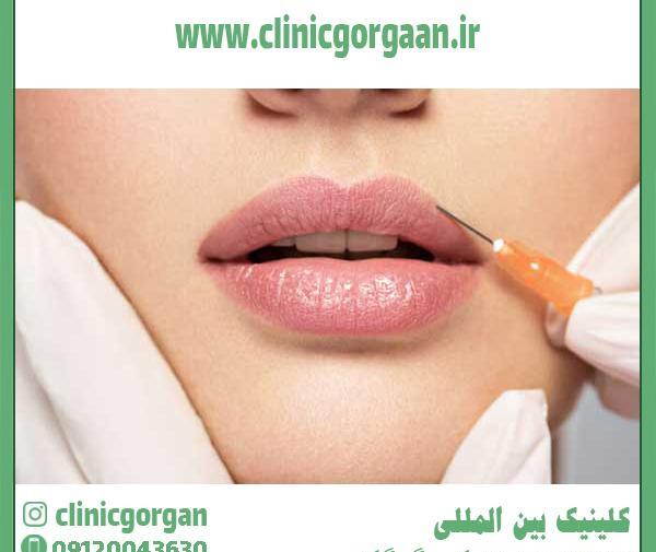 عکس لب پروتز شده خنده دار