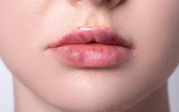 عکس لب های خونی