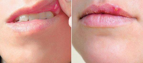 عکس لب های خونی