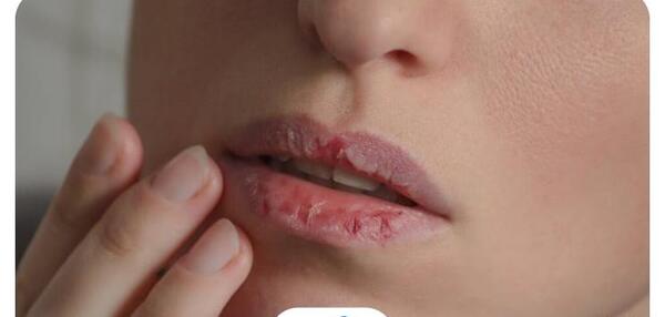 عکس لب های خونی