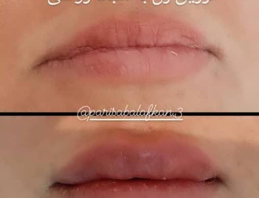 عکس ژل حجم دهنده لب