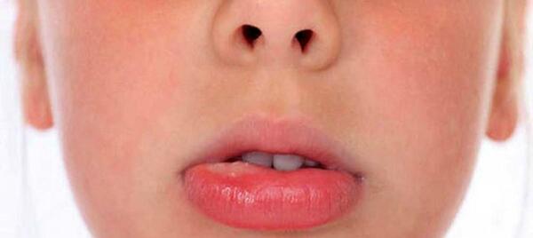 عکس لب های ترک خورده