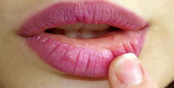عکس لب های ترک خورده