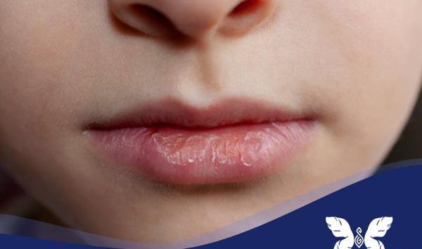 عکس لب های خشک و ترک خورده