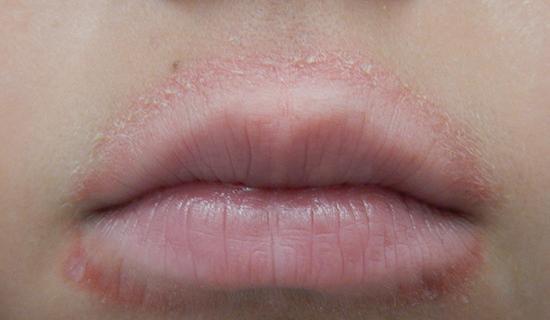 عکس لب های خشک و ترک خورده