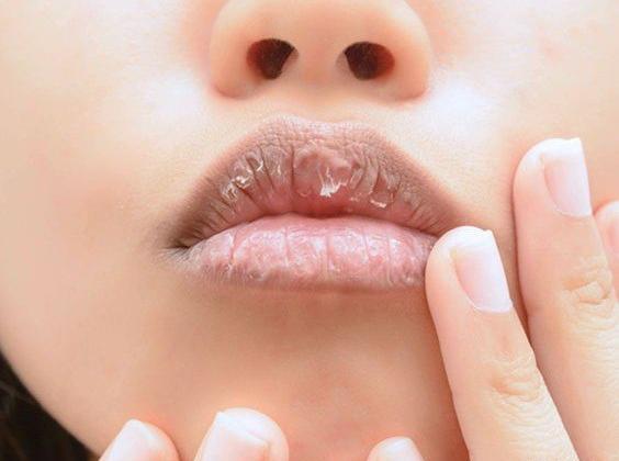 عکس لب های خشک و ترک خورده