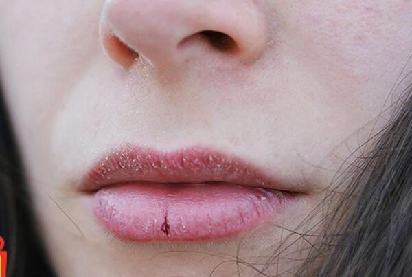 عکس لب های خشک و ترک خورده