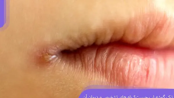 عکس لب های خشک و ترک خورده