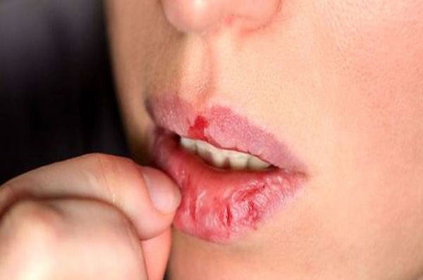 عکس لب های خشک و ترک خورده