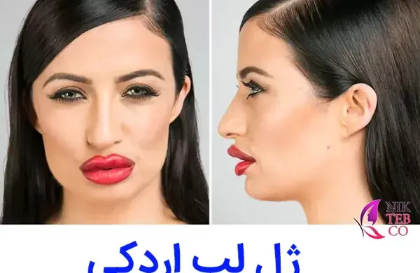 عکس ژل لب مدل اردکی