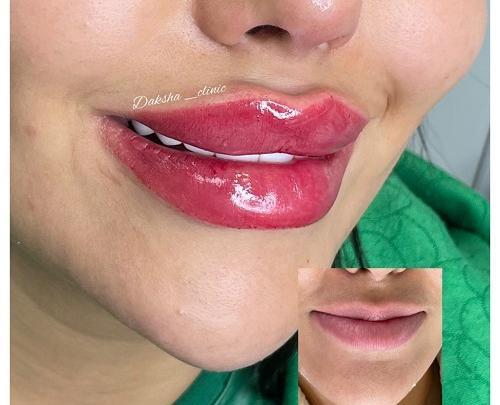 عکس ژل لب مدل اردکی