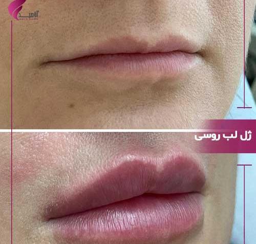 عکس ژل لب مدل اردکی