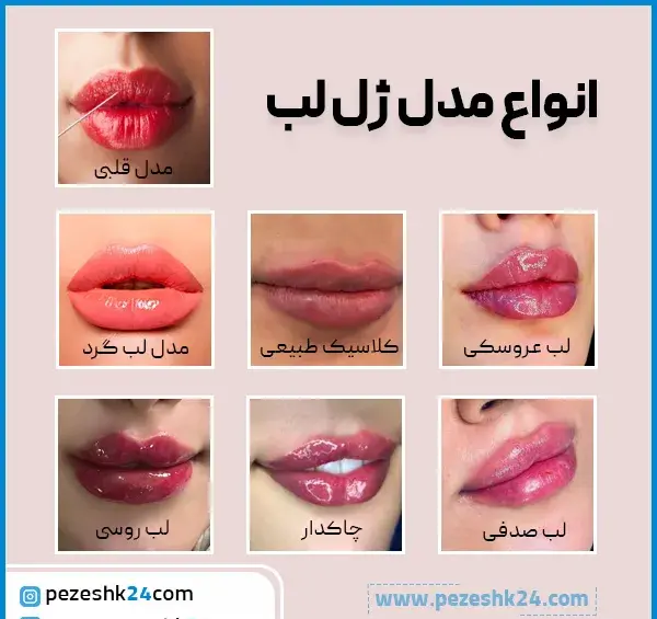 عکس ژل لب مدل اردکی