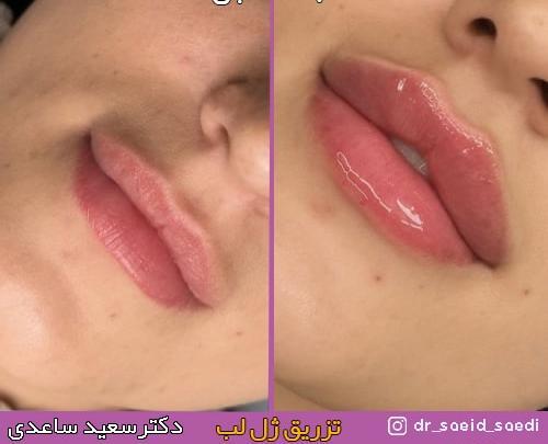 عکس ژل لب مدل اردکی