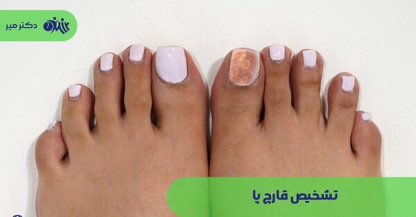 عکس عفونت قارچی ناخن پا