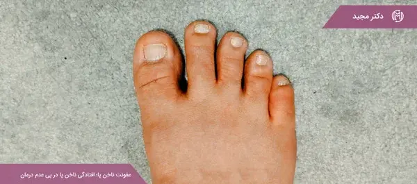 عکس عفونت قارچی ناخن پا