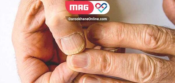 عکس ناخن های قاشقی