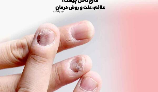 عکس ضد قارچ برای ناخن