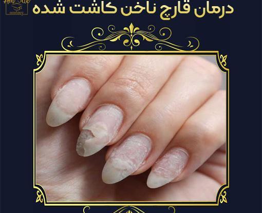 عکس ضد قارچ برای ناخن
