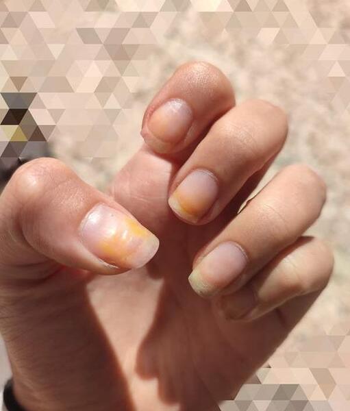 عکس زردی ناخن
