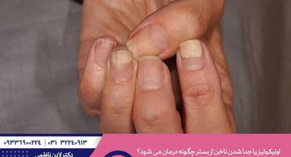عکس ناخن شکسته خونی