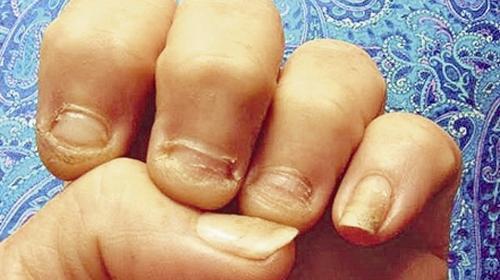 عکس عوارض ناخن جویدن