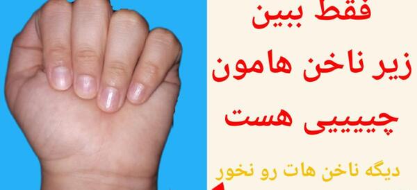 عکس ناخن جویده شده کودکان