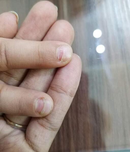 عکس ناخن افتاده دست
