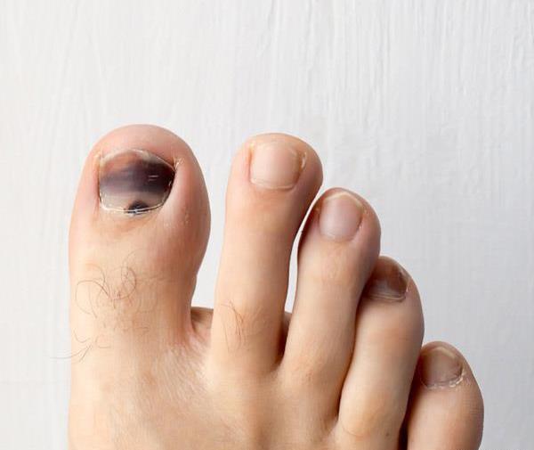 عکس ناخن افتاده دست