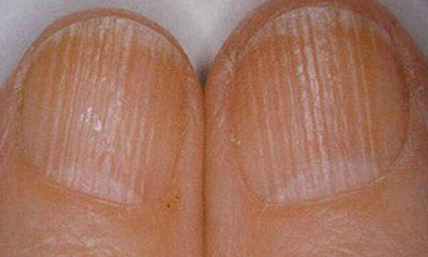 عکس ناخن بیمار ایدزی