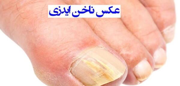 عکس ناخن بیمار ایدزی