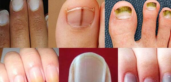 عکس ناخن بیمار ایدزی