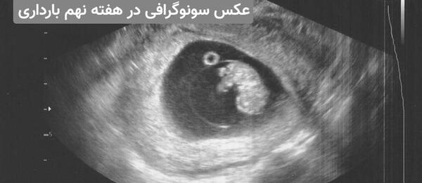 عکس سونو هشت هفته جنین پسر