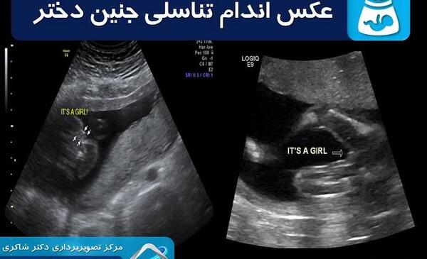 عکس سونوگرافی جنین پسر در سه ماهگی