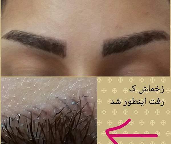 عکس فیبروز ابرو بعد از ترمیم نی نی سایت