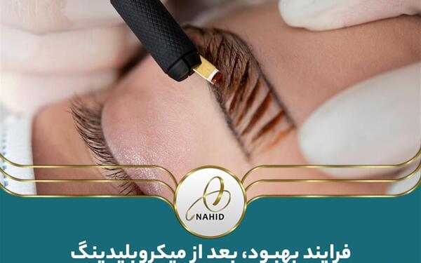 عکس فیبروز ابرو بعد از ترمیم نی نی سایت