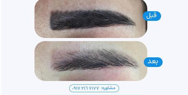 عکس فیبروز ابرو بعد از یک هفته نی نی سایت