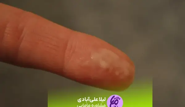 عکس ترشحات پنیری واژن در بارداری نی نی سایت