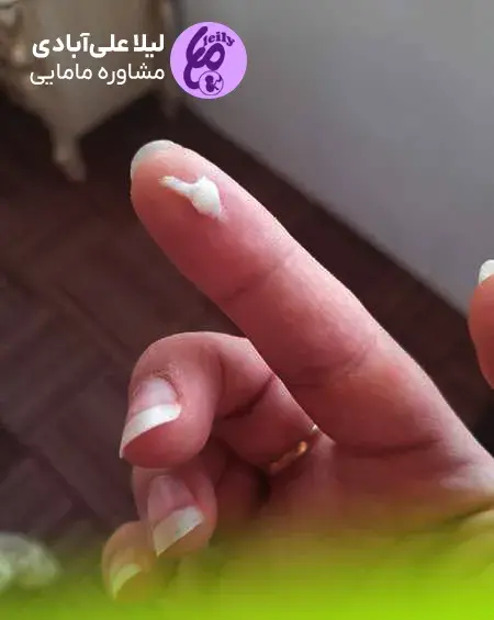 بارداری عکس ترشحات پنیری واژن نی نی سایت
